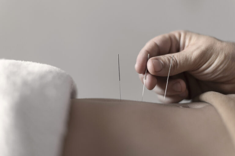Behandlung Akupunktur
